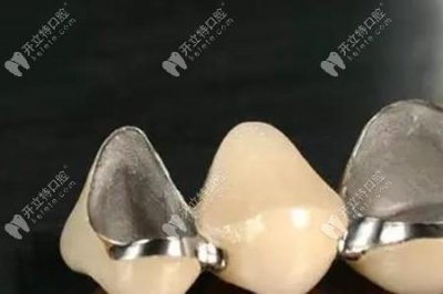 ​钴铬合金烤瓷牙优缺点