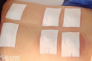 三九天贴伏贴吗 三九贴的作用有哪些