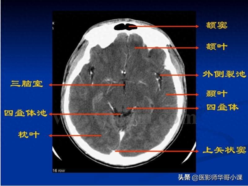 头颅（CT）解剖--精品图集