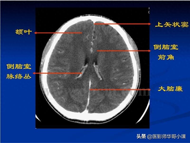 头颅（CT）解剖--精品图集