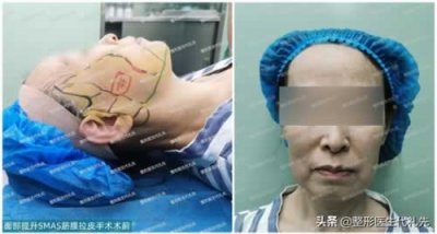 ​面部皮肤松弛 造成面部皮肤松弛的5大原因，提前预防重视改善，会看上去更年轻