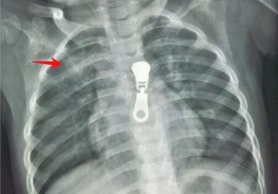 ​孩子肺炎啥症状(小孩子肺炎症状有哪些)