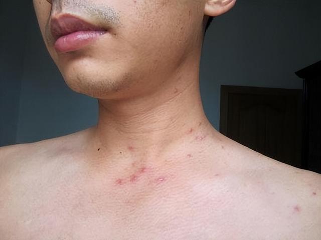 艾滋病前兆的几大症状（艾滋病早期有哪些信号）(3)