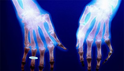 ​托法替布 托法替布治疗类风湿性关节炎多久见效？