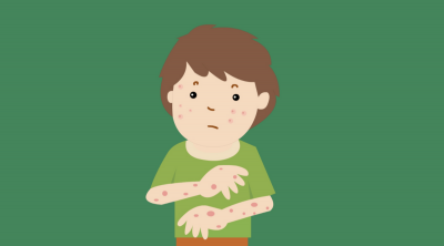 ​什么是过敏性紫癜,过敏性紫癜如何治疗好 什么是过敏性紫癜,过敏性紫癜如何治疗