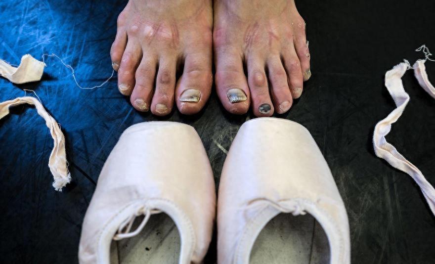 芭蕾舞者的美丽与艰辛 足部变形严重