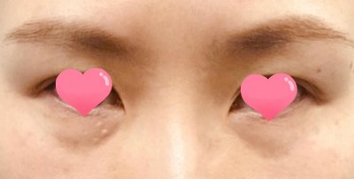 ​原来下眼皮烦人的小白点，是这个皮肤病。