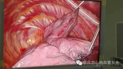 ​有图才有说服力-看看吸烟的肺什么样