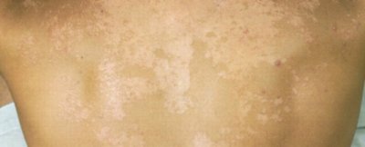 ​汗斑传染吗 汗斑为什么那么容易复发，已经很注意卫生为什么还会有？