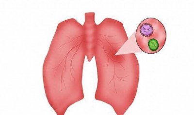 ​慢阻肺是什么病的简称 慢阻肺是啥意思