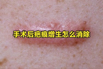 ​手术后疤痕增生怎么消除
