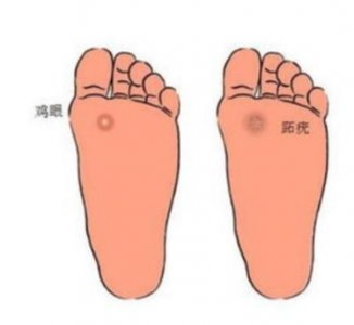 ​跖疣和鸡眼傻傻分不清楚？皮肤科医生教你几招辨别